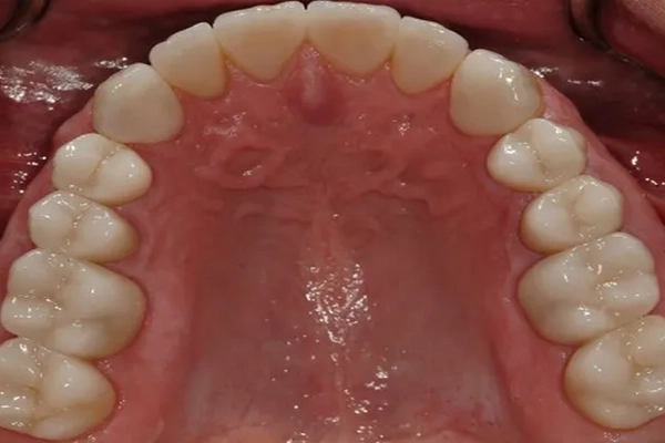 Mercury-Free Dentistry Before and Afters at Suite Dental