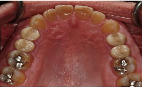 Mercury-Free Dentistry Before and Afters at Suite Dental