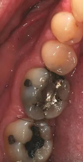 Mercury-Free Dentistry Before and Afters at Suite Dental